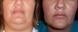 double chin liposuction birmingham alabama