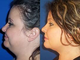 double chin liposuction Birmingham Alabama