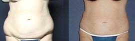 liposuction hips birmingham alabama