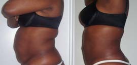 Alabama liposuction tummy tuck