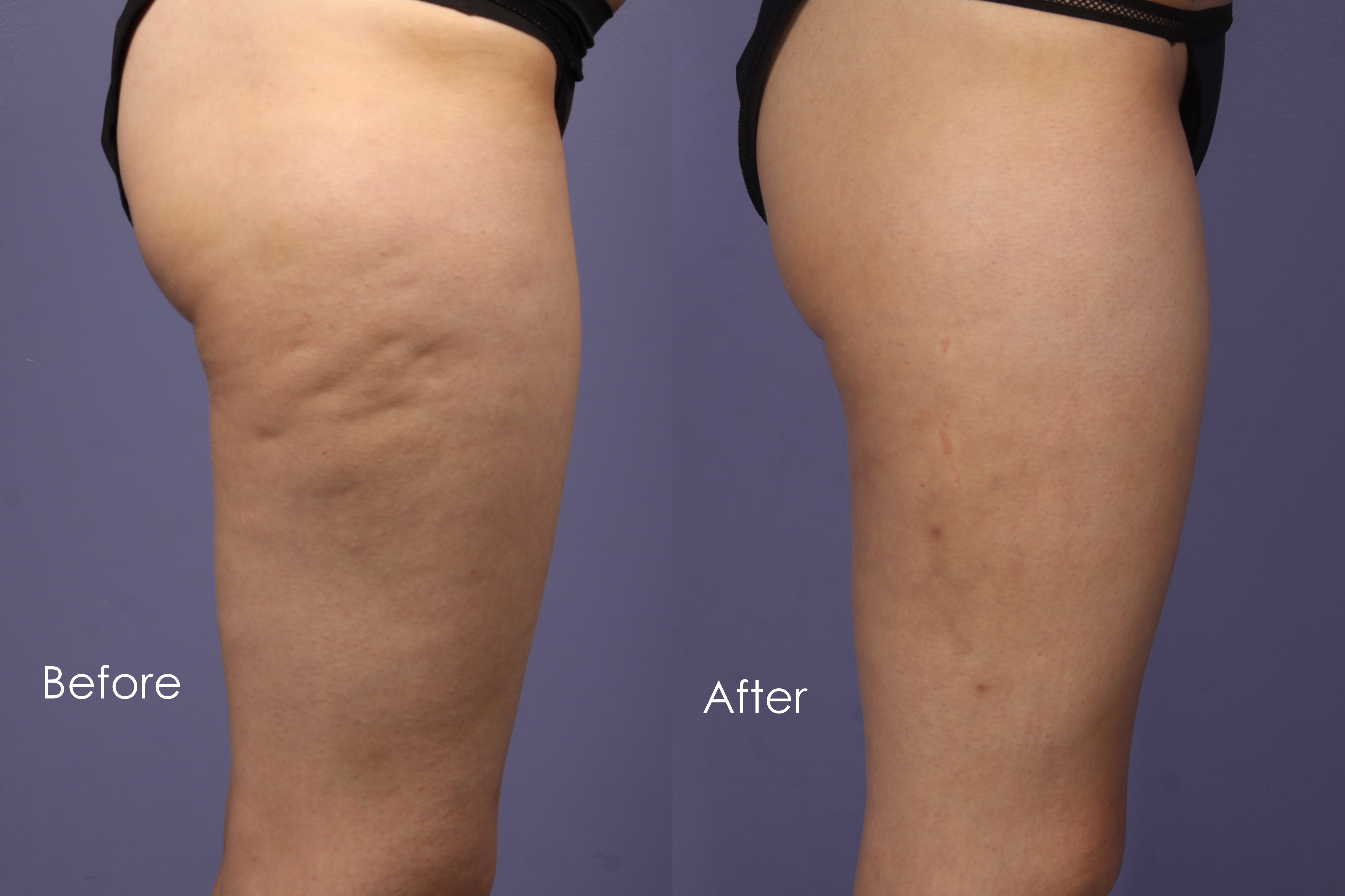 Cellulite Treatment | Vasershape | Cellulite Reduction ...